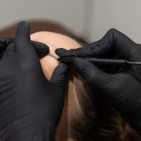 Prestation-Electrolyse-detail-Skinea-institut-beauté-roissy-en-brie